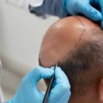 hair transplant
