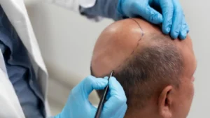 hair transplant